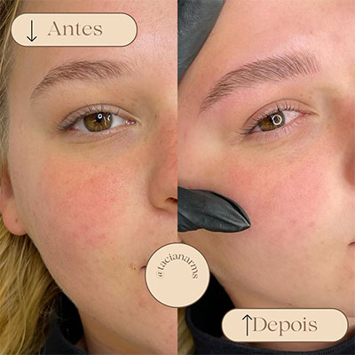 Antes/Depois da Micropigmentação Essence Brow